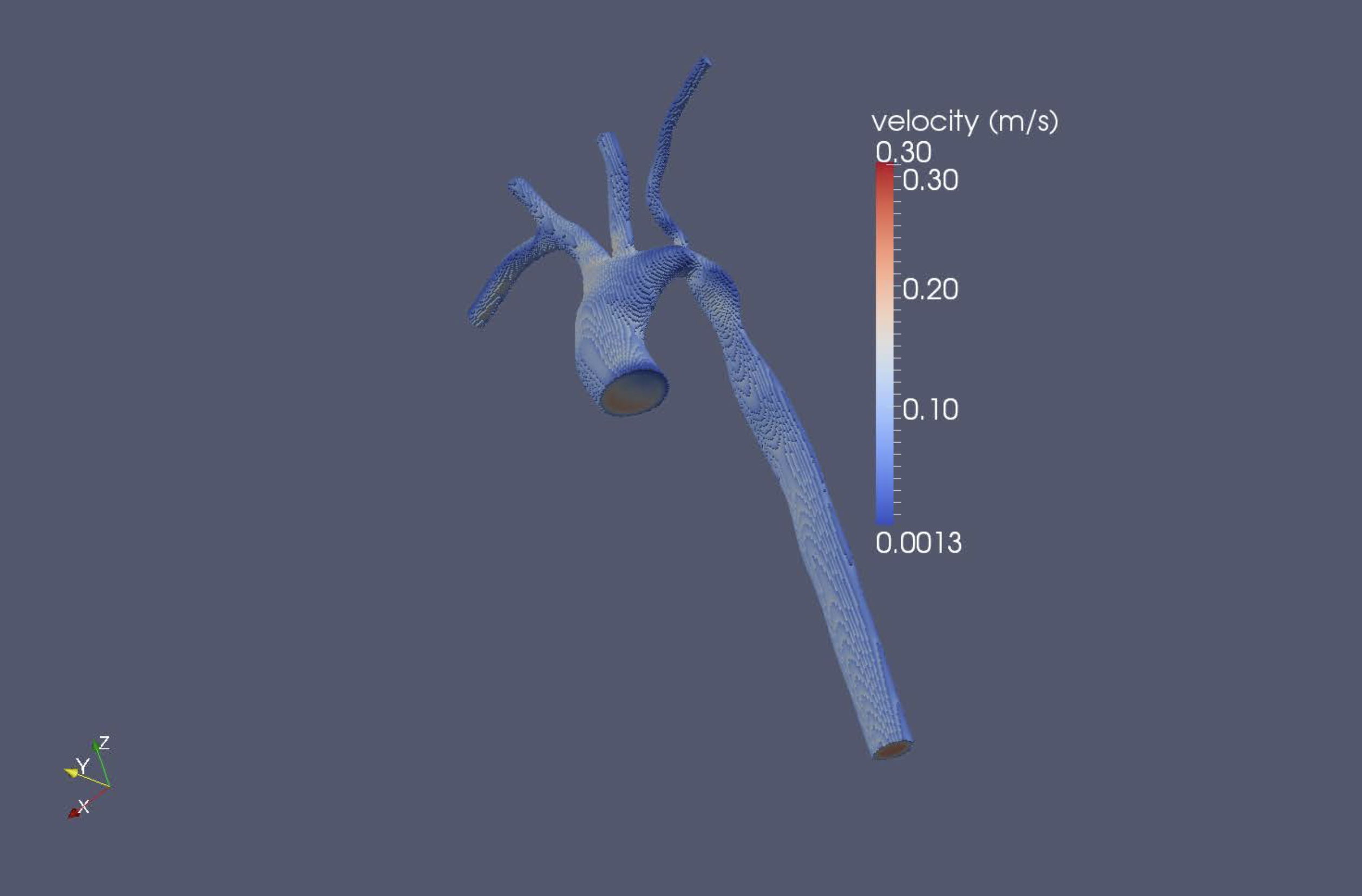 A lattice boltzmann simulation of hemodynamics in a patient-specific aortic coarctation model