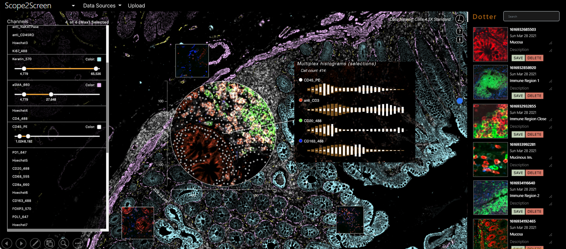 Scope2Screen: Focus+Context Techniques for Pathology TumorAssessment in Multivariate Image Data